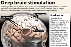 Deep brain stimulation